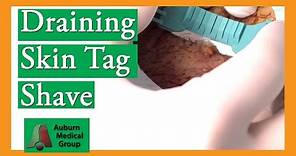 Shave Biopsy of Skin Tag with Sebaceous Cyst | Auburn Medical Group