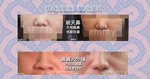 張宇正醫師 艾美整形診所－韓式隱痕縮鼻翼【內縮上提】效果大不同