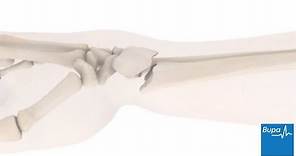 How a wrist fracture is treated