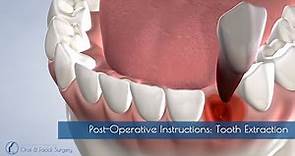 Post-Operative Instructions: Tooth Extraction