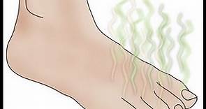 DermTV - How to Treat Foot Odors [DermTV.com Epi #388]