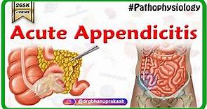 Acute appendicitis USMLE Step 1 : Etiology, Pathophysiology, Clinical Features, Diagnosis, Treatment