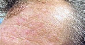 10 Best Actinic Keratosis Home Treatment