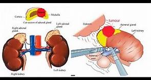 Adrenalectomy: Surgical Removal of the Adrenal Glands