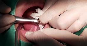 潔明牙醫診所 - #水雷射舌繫帶切除術