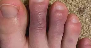 What are COVID toes?