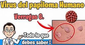 VIRUS del PAPILOMA HUMANO verrugas Sintomas, TRATAMIENTO y PREVENCION VPH | HPV
