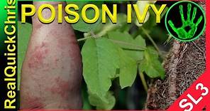 poison ivy rash identification and symptoms with treatment