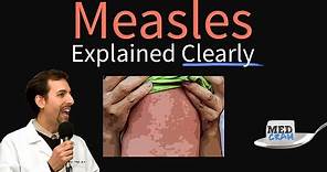 Measles (rubeola) Explained Clearly by MedCram.com