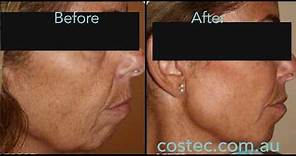 HIFU™ treatment - Before & After pictures for Face Lift and Skin Tightening