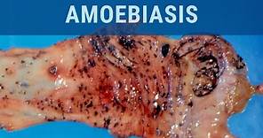 Amoebiasis - Pathology mini tutorial