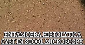 Entamoeba Histolytica Cyst under stool microscopy. MLT WORLD.