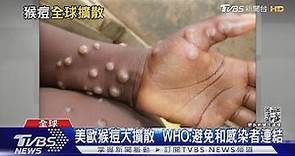 紐約.以色列爆猴痘疫情 全球逾14國破百例｜TVBS新聞