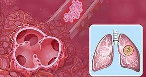 Comprender el cáncer de pulmón de células no pequeñas