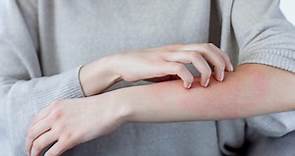 Skin Allergies | Causes, Symptoms & Treatment | ACAAI Public Website