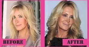 Joan Van Ark Before and After Plastic Surgery Photos