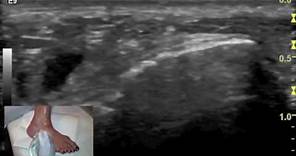 Ultrasound tutorial - Imaging of the peroneal tendons