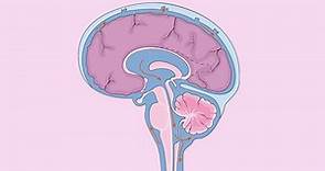 Edema cerebral: síntomas, tipos, tratamiento y evolución