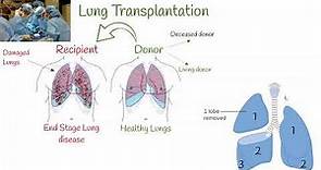 Lung Transplant Surgery, Survival, Organ Rejection. Risk-Benefit