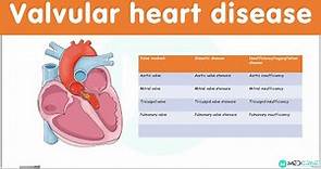 Valvular Heart Diseases: Classification, Causes, Pathophysiology, Diagnosis and Treatment