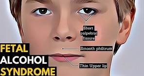 Fetal Alcohol Syndrome, Causes, Signs and Symptoms, Diagnosis and Treatment.