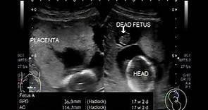 Ultrasound Video showing twin pregnancy with one alive and one dead fetus.