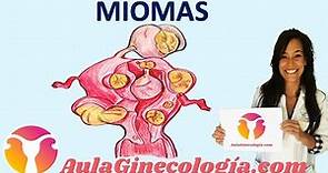 MIOMAS: Síntomas, diagnóstico y tratamiento de los miomas - Ginecología y Obstetricia
