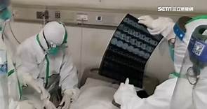 武漢肺炎／歐洲首例X光片曝光 肺部呈現恐怖「毛玻璃狀」