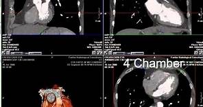 Coronary CT Angiography: RCA Stenosis