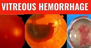 VITREOUS HEMORRHAGE || Everything you need to know