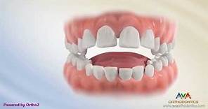 Orthodontic Treatment for Tongue Thrusting Habit - Different Options