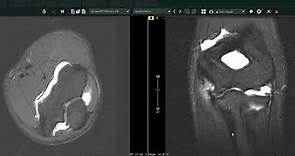 Looking Inside An Elbow MRI at Atlantic Medical Imaging
