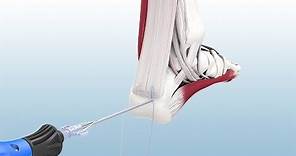 Haglund's Excision and Achilles Reconstruction Using the CuffLink™ System - CONMED Animation