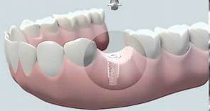 Cómo se coloca un implante dental