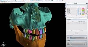 V4.12 Completely Automatic CT Teeth and Bone Segmentation in BSP