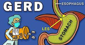 Gastroesophageal Reflux Disease (GERD)