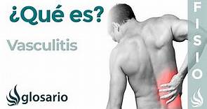 VASCULITIS | Qué es, qué estructuras afecta, síntomas, signos clínicos, causas y tratamiento