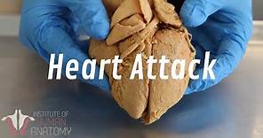 What Happens During a Heart Attack | Anatomy of a Heart Attack