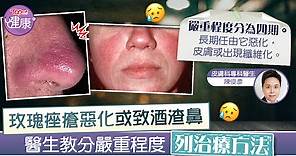 【玫瑰痤瘡】任由玫瑰痤瘡惡化或致酒渣鼻　醫生教分嚴重程度列治療方法 - 香港經濟日報 - TOPick - 健康 - 醫生診症室
