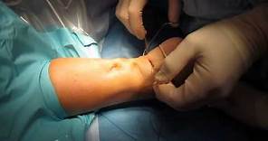 Percutaneous Achilles Tendon Surgery Repair (Unedited) by Kevin R. Stone, MD