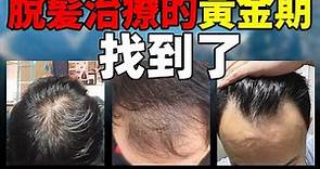 【脫髮治療】脫髮治療的3個階段 找准脫髮治療“黃金期”丨植髮醫生李丙雙