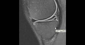 Knee MRI Scan of a Meniscus Tear | First Look MRI