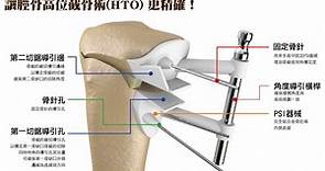 影／3D列印技術導入精準矯治 膝關節炎患者福音 | 生活 | NOWnews今日新聞