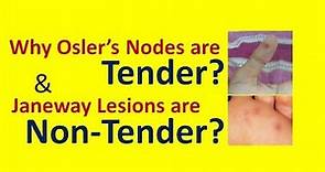 Why Osler's Nodes are Painful while Janeway Lesions are Painless?