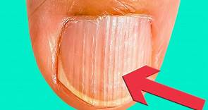 为什么指甲上有竖纹？解析关于指甲的2种常见现象！