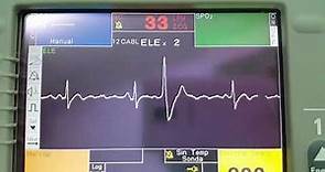 Extrasistole ventricular electrocardiograma 😼😼