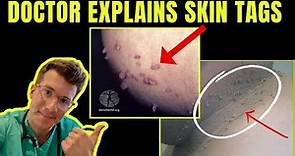 Doctor explains SKIN TAGS - including CLINICAL PHOTOS, CAUSES & TREATMENT