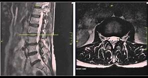 Lumbar Disc Herniation MRI Explained | Dr. Jeffrey P. Johnson | HD