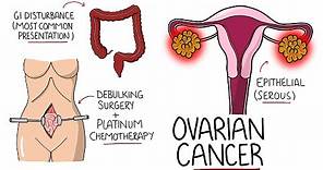 Ovarian Cancer Explained (Including Subtypes)