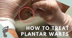 How To Treat Plantar Warts